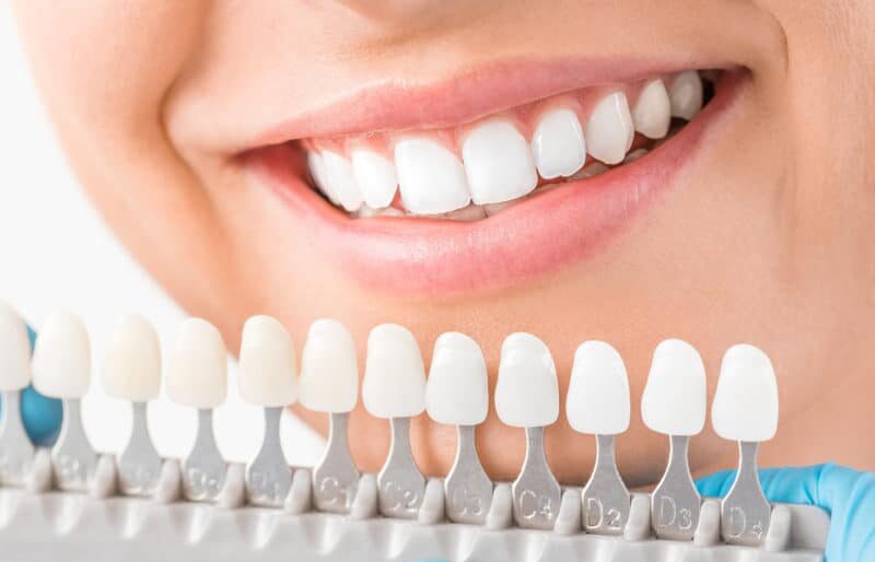 Different Methods of Teeth Whitening: Which Option Is Best for You